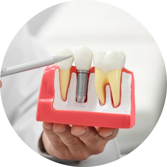 Dental Implants